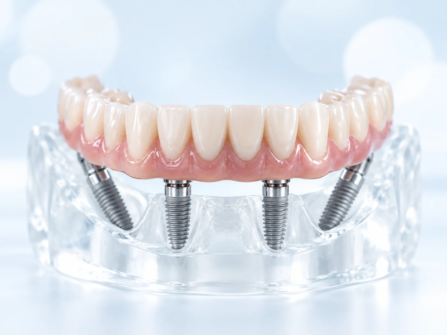 Festsitzender Zahnersatz auf mehreren Implantaten
